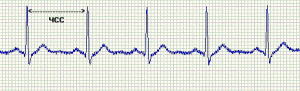 Показатели и расшифровка экг сердца